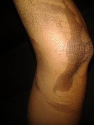 Photo, prise par l'association Entraides citoyennes, de brûlures observées sur le bras d'une femme agressée fin août.