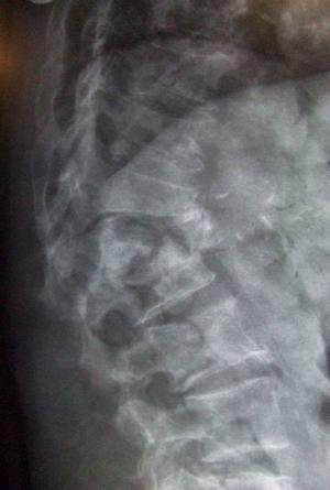 Fracture de vertèbre liée à l'ostéoporose