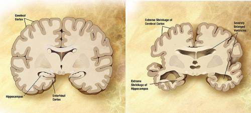 Cerveau normale (à gauche) et cerveau d'un patient atteint d'Alzheimer