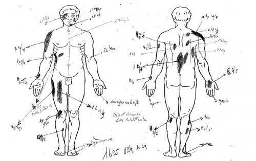 Schéma montrant le smultiples héméatomes relevés sur le corps d&#039;Ali Ziri lors de la seconde autopsie.