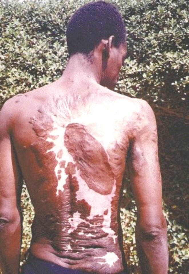 Le dos d'Amidou Ouedraogo codétenu de David Ouedraogo après avoir été torturé © DR Le dos d'Amidou Ouedraogo codétenu de David Ouedraogo après avoir été torturé © DR