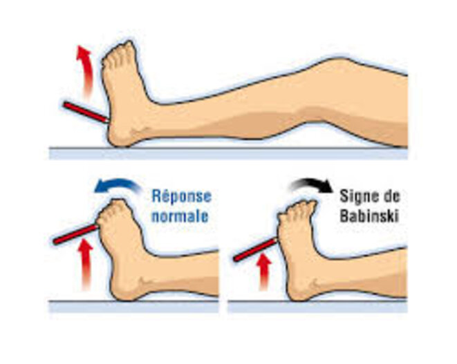 babinski2