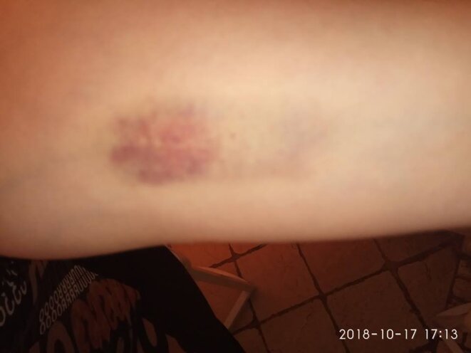 Blessures d'arrestation musclée © Gennadii Esaulov Blessures d'arrestation musclée © Gennadii Esaulov