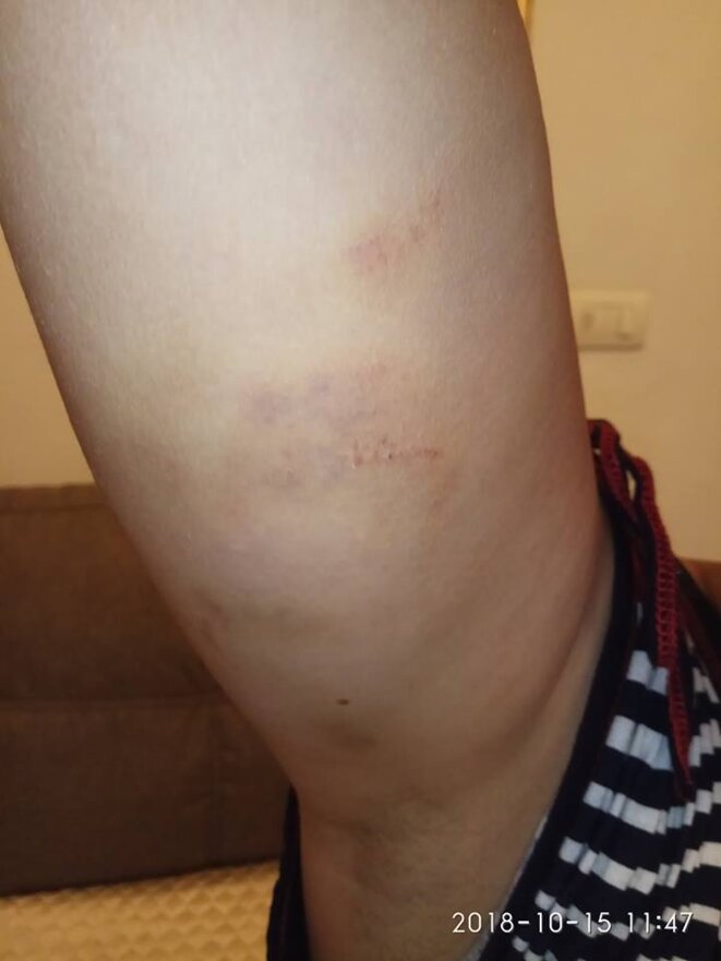 Blessures d'arrestation musclée © Gennadii Esaulov Blessures d'arrestation musclée © Gennadii Esaulov