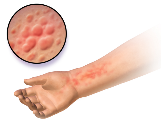 urticaria