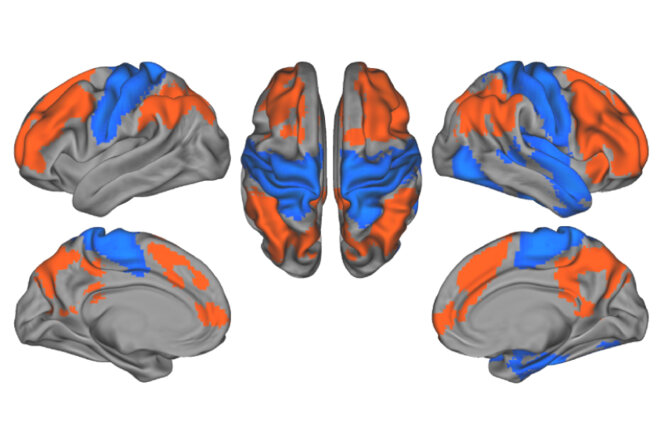 Le cerveau humain en quatre vues Des signaux tachetés : La communication dans le cerveau autiste peut être fréquente dans certaines parties (rouge) et intermittente dans d'autres (bleu). © Spectrum News