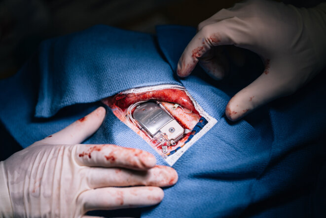 Je l'ai bordé : L'implant se visse directement dans le crâne de Kevin pour le maintenir en place, avec des fils supplémentaires au sommet au cas où ils seraient nécessaires plus tard. Je l'ai bordé : L'implant se visse directement dans le crâne de Kevin pour le maintenir en place, avec des fils supplémentaires au sommet au cas où ils seraient nécessaires plus tard.