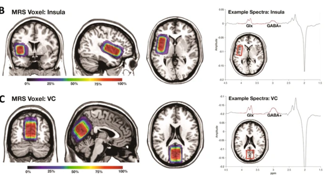 extrait Fig. 1: Flow diagram and VOIs in MRS. © Translational Psychiatry extrait Fig. 1: Flow diagram and VOIs in MRS. © Translational Psychiatry