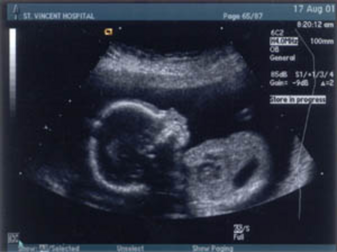Temoignage 6 Naissance De Brandon Enfant Atteint D Anencephalie Le Club De Mediapart Temoignage 6 Naissance De Brandon Enfant Atteint D Anencephalie Le Club De Mediapart
