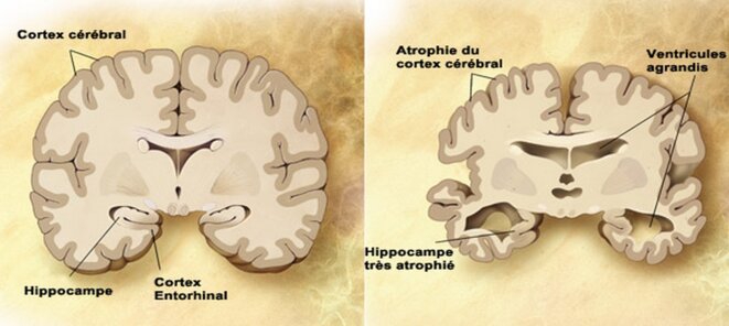 Représentation schématique d’une coupe transversale de cerveau sain (à gauche) et l’atrophie massive d’un cerveau à un stade avancé d’Alzheimer (à droite). Source : National Institute on Aging, National Institutes of Health. Représentation schématique d’une coupe transversale de cerveau sain (à gauche) et l’atrophie massive d’un cerveau à un stade avancé d’Alzheimer (à droite). Source : National Institute on Aging, National Institutes of Health.
