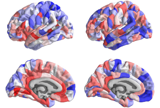 Images du cerveau codées par couleurs (en rouge et en bleu) pour montrer les changements structurels de l'autisme. Images du cerveau codées par couleurs (en rouge et en bleu) pour montrer les changements structurels de l'autisme.