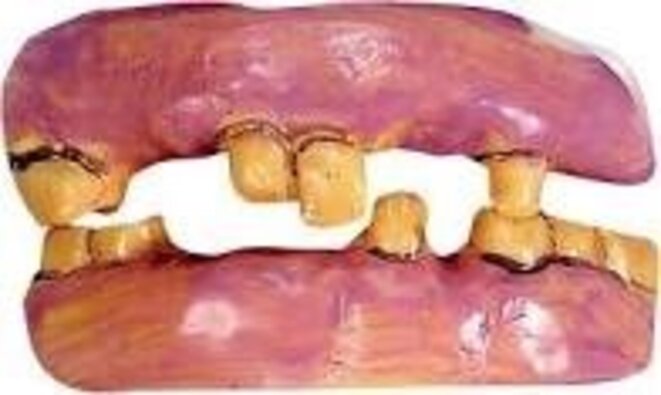 dents-pourris