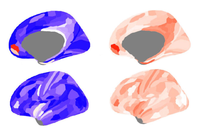Cerveau masculin : Les hommes autistes présentent un plus grand déséquilibre de signalisation dans le cerveau, en particulier dans le cortex préfrontal médian (en haut), que les hommes typiques ou les femmes autistes ou typiques. Cerveau masculin : Les hommes autistes présentent un plus grand déséquilibre de signalisation dans le cerveau, en particulier dans le cortex préfrontal médian (en haut), que les hommes typiques ou les femmes autistes ou typiques.