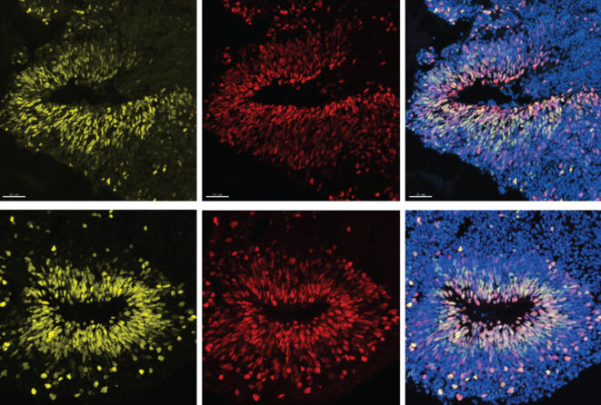 Surcroissance précoce : Au cours de leurs premières semaines de développement, les organoïdes ayant deux copies intactes du gène CHD8 (en haut) ont développé des neurones excitateurs plus lentement que les organoïdes auxquels il manquait une copie du gène (en bas). Surcroissance précoce : Au cours de leurs premières semaines de développement, les organoïdes ayant deux copies intactes du gène CHD8 (en haut) ont développé des neurones excitateurs plus lentement que les organoïdes auxquels il manquait une copie du gène (en bas).