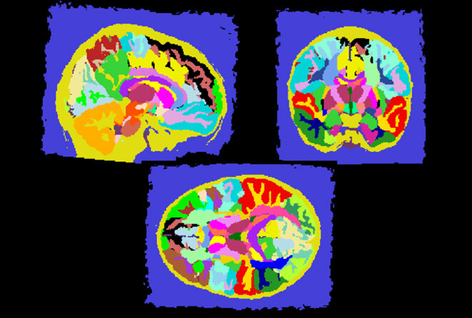© Derek Andrews / Université de Californie, Davis MIND Institute © Derek Andrews / Université de Californie, Davis MIND Institute