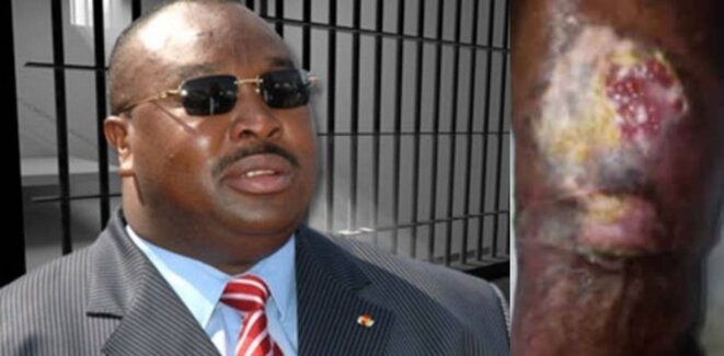 Togo : Kpatcha Gnassingbé risque une amputation, faute d’évacuation sanitaire.