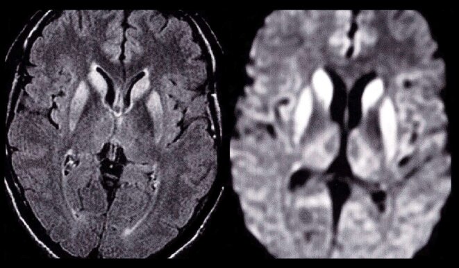 Imagerie d’un cerveau atteint par la maladie de maladie de Creutzfeldt-jakob. © BSIP via AFP