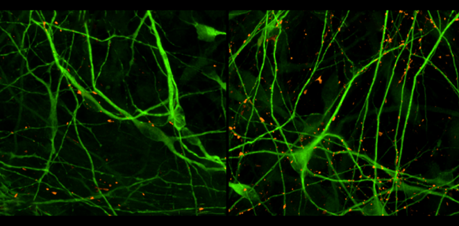 Autisme : Des organoïdes identifient des thérapies potentielles et des défauts