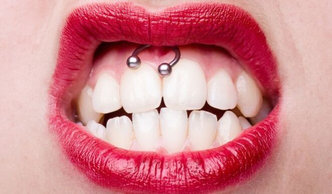 Des soins dentaires adaptés au niveau sensoriel réduisent le stress des autistes