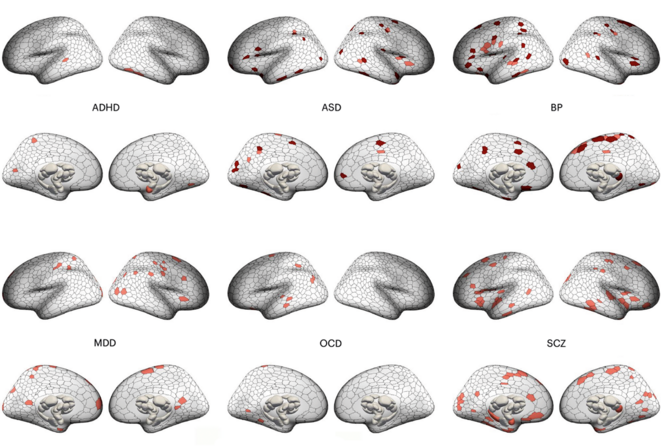 Image de recherche de scanners cérébraux montrant des différences de volume de matière grise dans six conditions psychiatriques (en rose et en rouge).