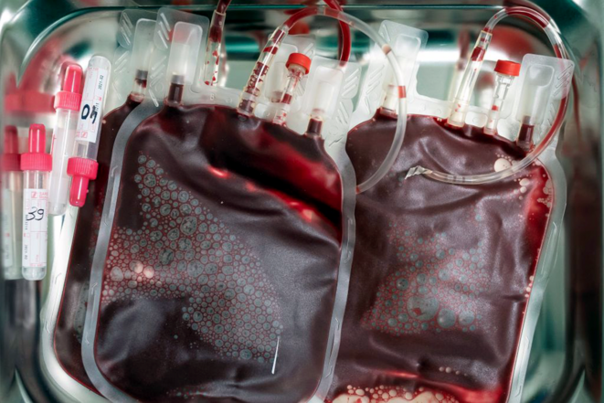 Autisme : Pourquoi l'engouement pour les thérapies de cellules souches persiste ?