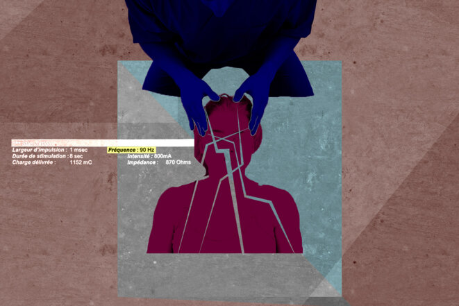 Psychiatrie: une jeune femme subit 85 séances d’électrochocs et perd la mémoire