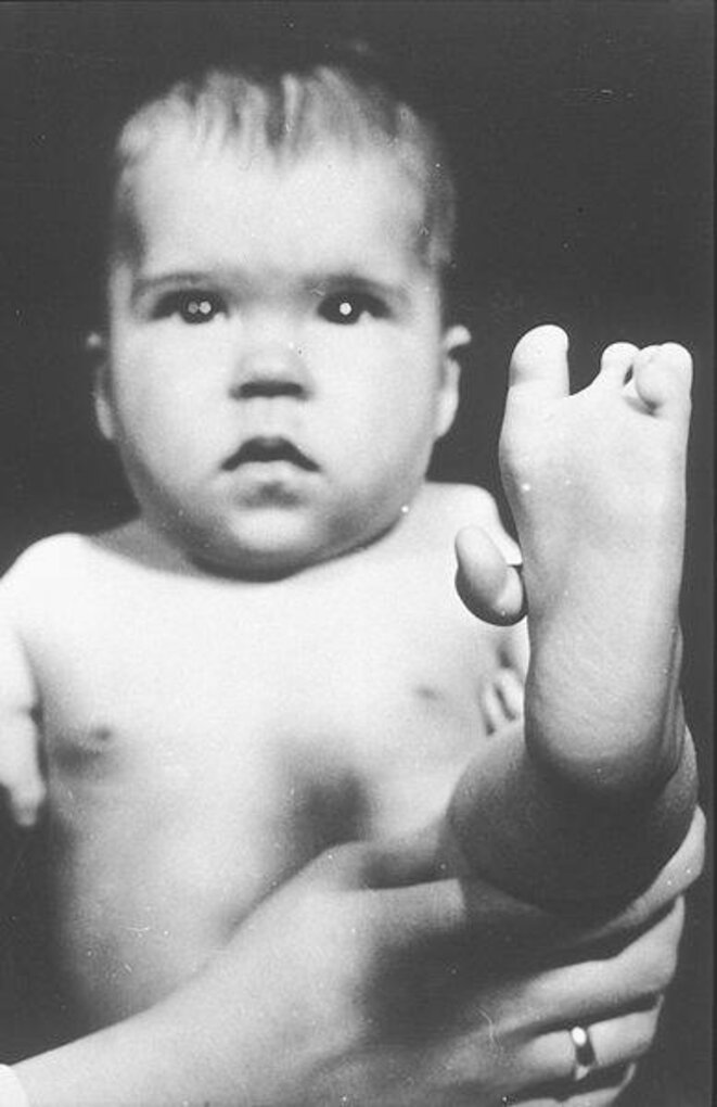Bébé victime de la thalidomide © DR Bébé victime de la thalidomide © DR