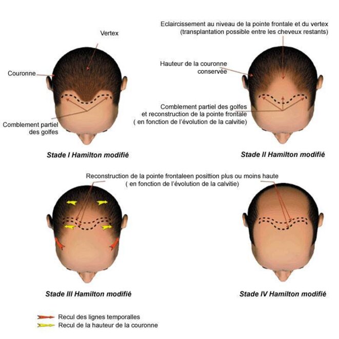 Se faire des cheveux...