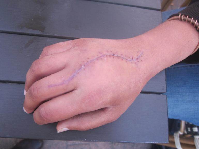 Elsa Moulin a failli perdre sa main après un jet de grenade par un gendarme.